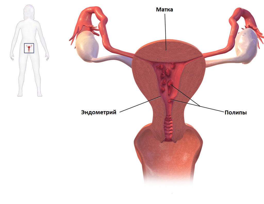 Полипы эндометрия | Медицинский центр Эра