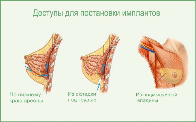 Подтяжка груди