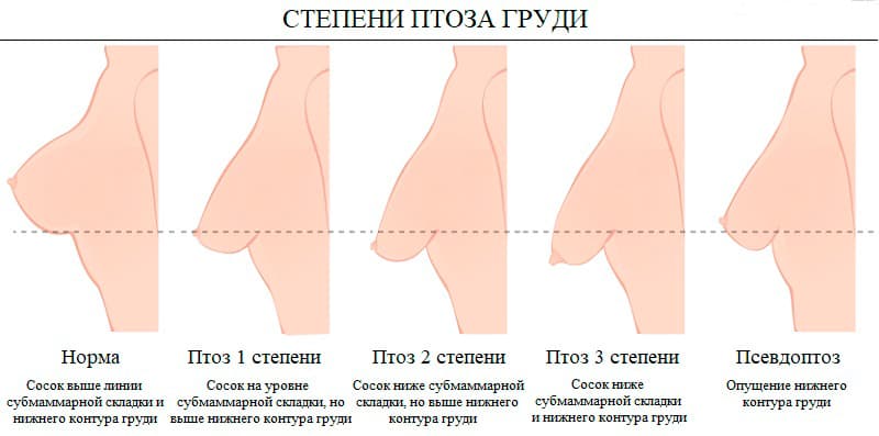 Пластическая операция - подтяжка груди (мастопексия)