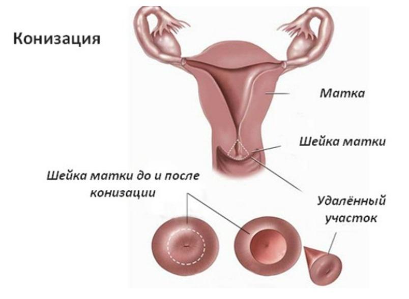 Выделения после удаления матки. Конизация шейки матки лазером. Диатермоконизация шейки матки. Петлевая конизация шейки матки.